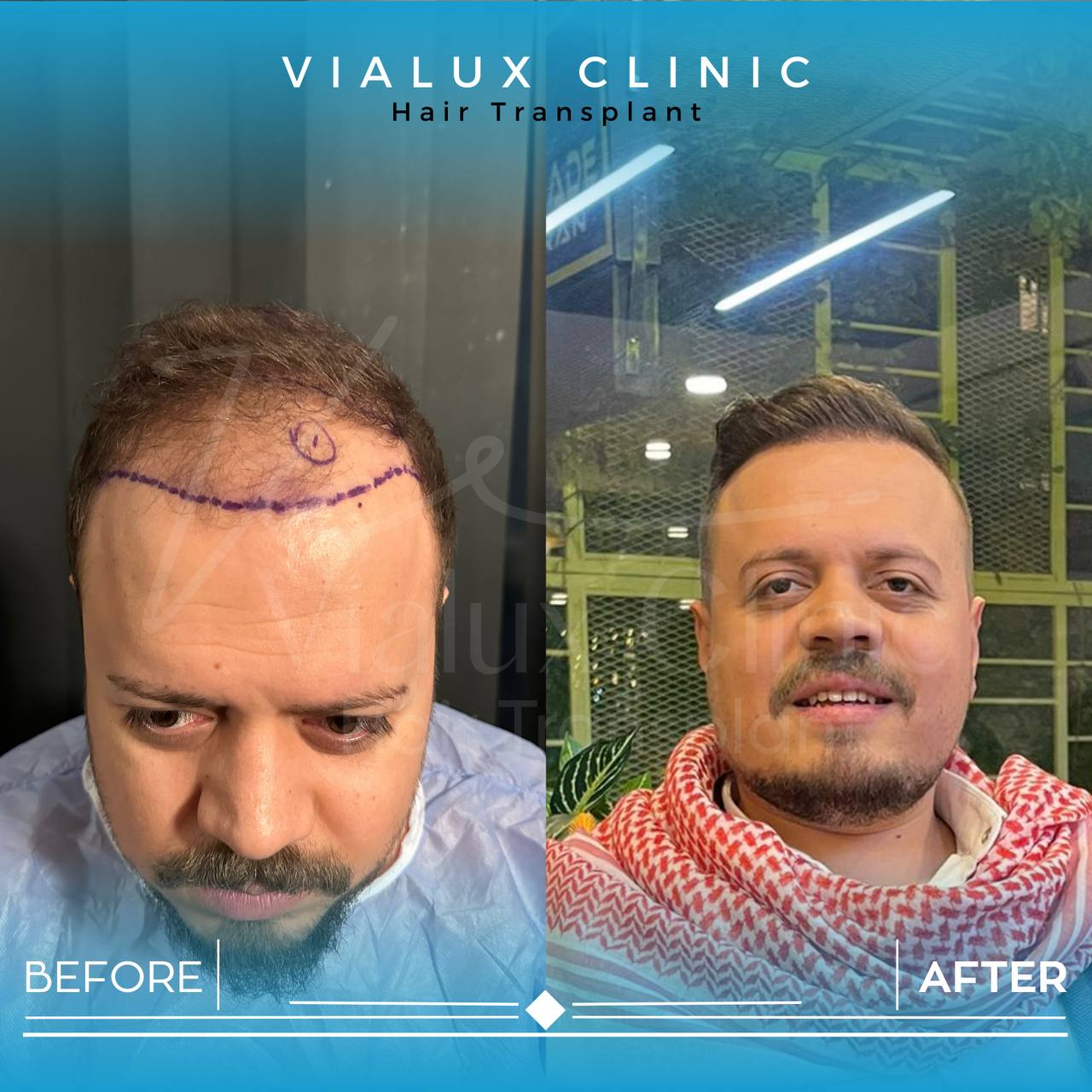 Vialux Clinic&apos;te Ankara&apos;da saç ekimi öncesi ve sonrası sonuçlar