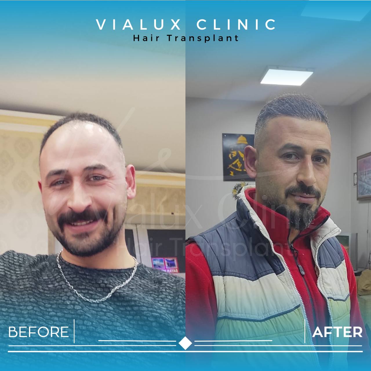 Vialux Clinic&apos;te Ankara&apos;da saç ekimi öncesi ve sonrası sonuçlar